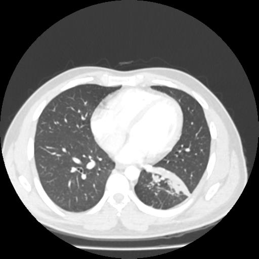 File:Bronchial carcinoid (Radiopaedia 80013-93291 Axial lung window 79).jpg