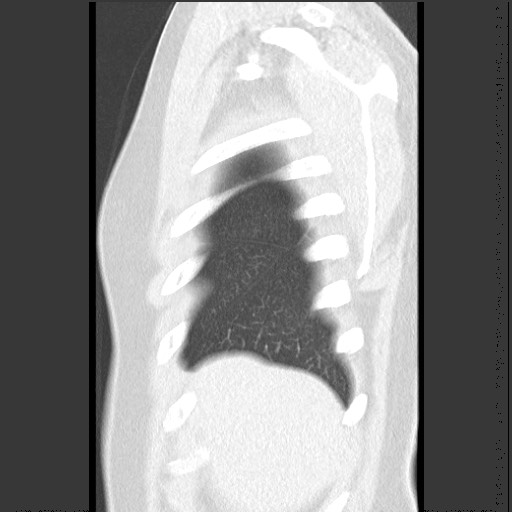 File:Bronchial carcinoid tumor (Radiopaedia 67377-76764 Sagittal lung window 9).jpg