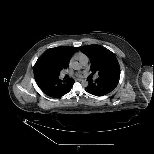 Bronchial carcinoid tumor (Radiopaedia 78272-90870 Axial non-contrast 50).jpg