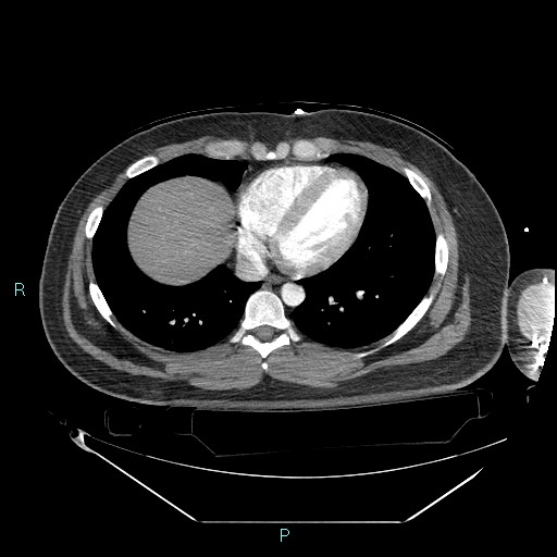 File:Bronchial carcinoid tumor (Radiopaedia 78272-90870 B 85).jpg