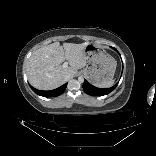 Bronchial carcinoid tumor (Radiopaedia 78272-90870 C 110).jpg