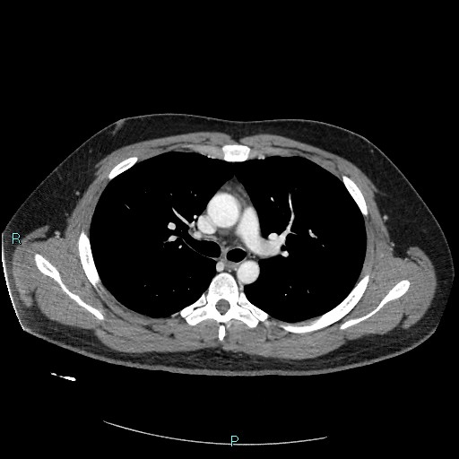 Bronchial carcinoid tumor (Radiopaedia 78272-90875 A 42).jpg