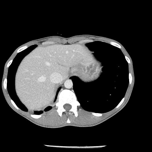 Bronchial carcinoid tumor causing right lower lobe collapse (Radiopaedia 83495-98594 A 48).jpg