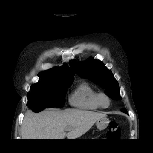 Bronchial stenosis - lung transplant (Radiopaedia 73133-83848 Coronal non-contrast 19).jpg