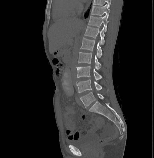 File:Bronchiectasis in Crohn disease (Radiopaedia 60311-67977 Sagittal bone window 114).jpg