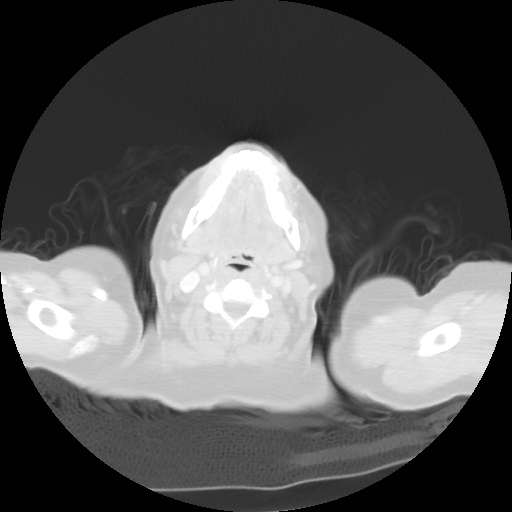 Bronchogenic carcinoma (Radiopaedia 73497-84262 Axial lung window 4).jpg