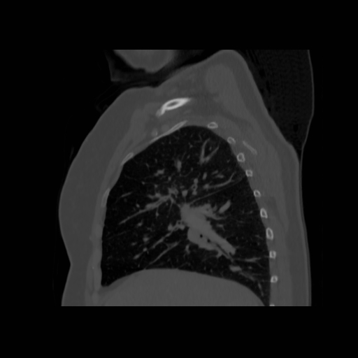 File:Bronchogenic carcinoma (Radiopaedia 73497-84262 Sagittal bone window 57).jpg