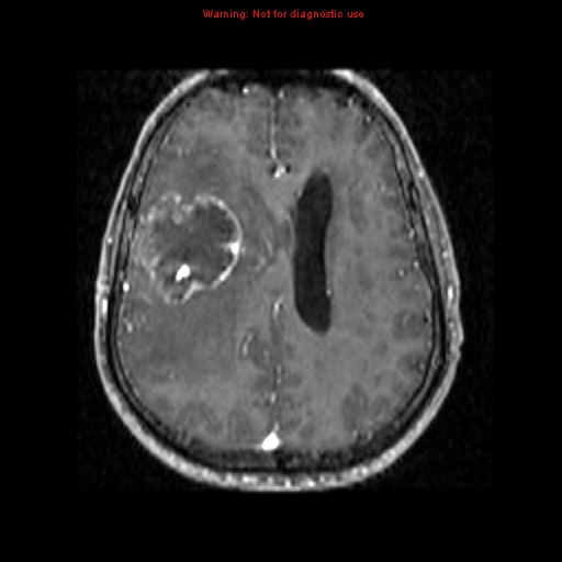 File:Bronchogenic carcinoma brain metastasis (Radiopaedia 9286-9969 Axial T1 C+ 12).jpg