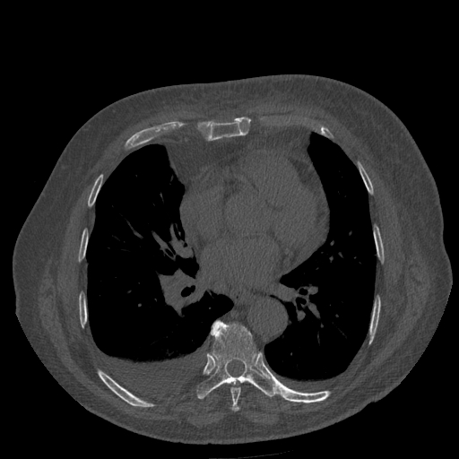 Bronchogenic carcinoma with metastatic lymphadenopathy (Radiopaedia 37671-39569 Axial bone window 33).jpg