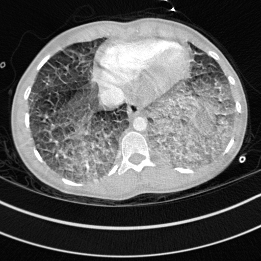Bronchogenic cyst (Radiopaedia 77801-90071 Axial lung window 66).jpg