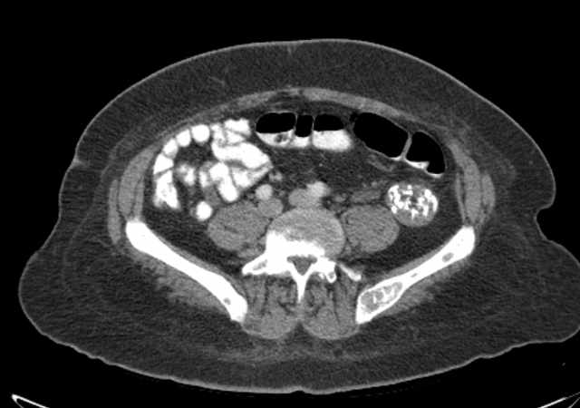 File:Brown tumors compressing the spinal cord (Radiopaedia 68442-77988 E 83).jpg