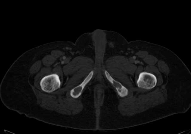 Brown tumors compressing the spinal cord (Radiopaedia 68442-77988 G 138).jpg