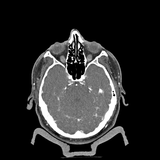 Buccal fat pad arteriovenous malformation (Radiopaedia 70936-81144 D 271).jpg
