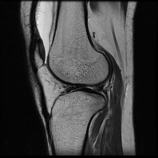 File:Bucket handle meniscus tear (Radiopaedia 56916-63751 Sagittal T2 7).jpg