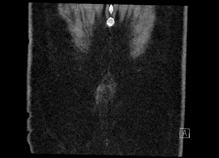 File:Buried bumper syndrome - gastrostomy tube (Radiopaedia 63843-72577 Coronal Inject 138).jpg