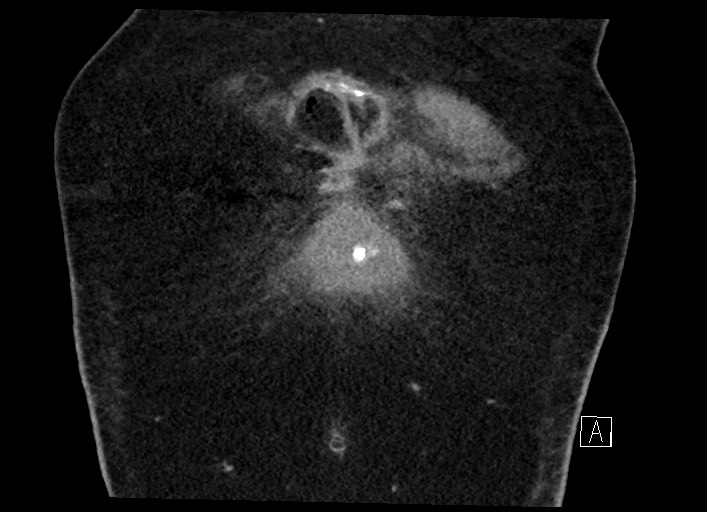 Buried bumper syndrome - gastrostomy tube (Radiopaedia 63843-72577 Coronal Inject 15).jpg