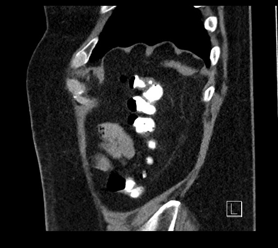 Buried bumper syndrome - gastrostomy tube (Radiopaedia 63843-72577 Sagittal Inject 15).jpg