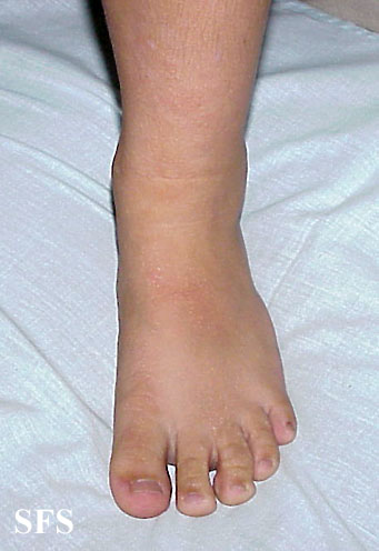 Buschke-Ollendorf Syndrome (Dermatology Atlas 8).jpg