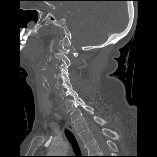File:C1 anterior arch (plough) fracture - type 1 (Radiopaedia 76181-87720 Sagittal bone window 47).jpg
