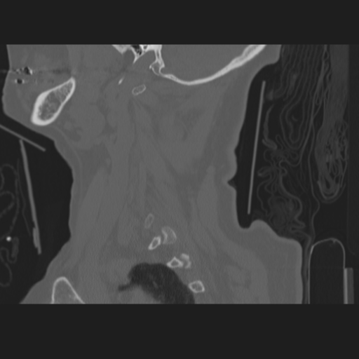 C2 fracture (Radiopaedia 34091-35341 Sagittal bone window 15).png