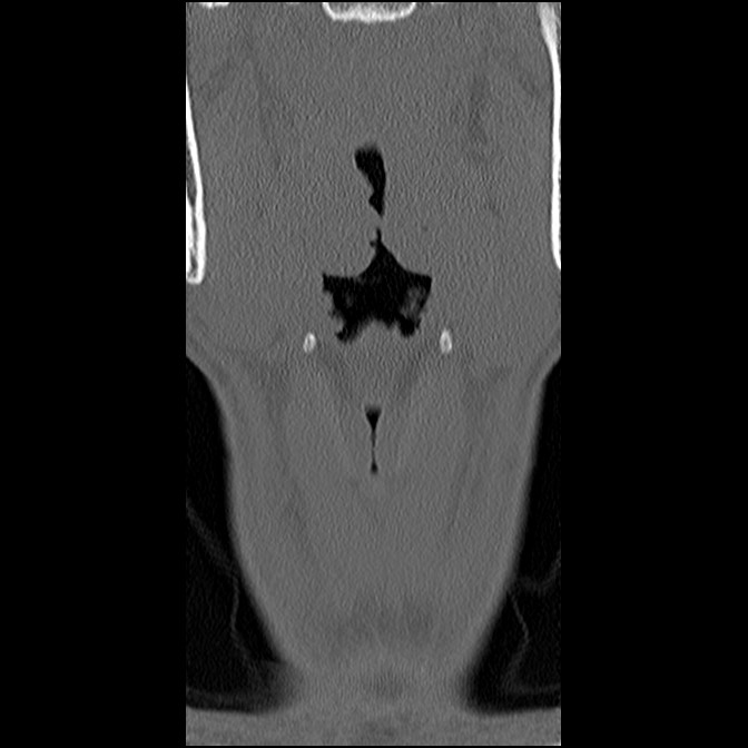 C5 facet fracture (Radiopaedia 58374-65499 Coronal bone window 9).jpg