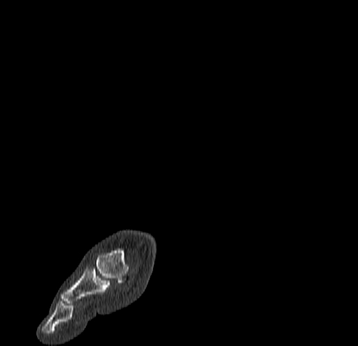 Calcaneal fracture - Sanders type 4 (Radiopaedia 90179-107370 Sagittal bone window 9).jpg