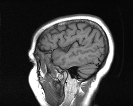 File:Calcified cerebral hydatid cyst (Radiopaedia 65603-74699 Sagittal T1 18).jpg