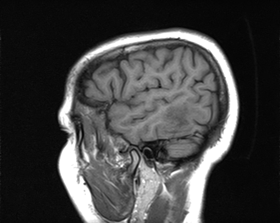 File:Calcified cerebral hydatid cyst (Radiopaedia 65603-74699 Sagittal T1 3).jpg
