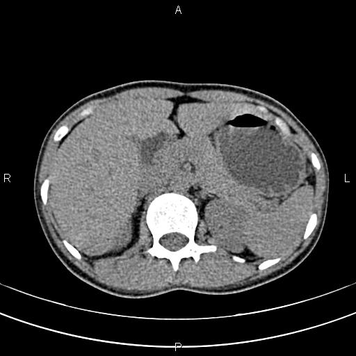 File:Calcified hepatic hydatid cyst (Radiopaedia 83870-99072 Axial non-contrast 52).jpg