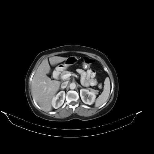 File:Calcified hydatid cyst of the liver (Radiopaedia 21212-21112 A 12).jpg