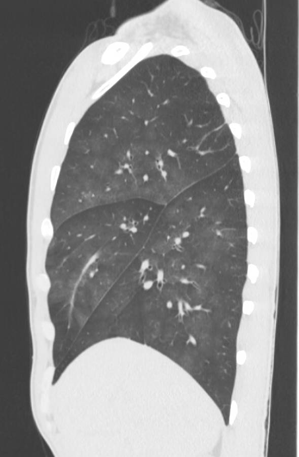 Cannabis-induced diffuse alveolar hemorrhage (Radiopaedia 89834-106946 Sagittal lung window 36).jpg