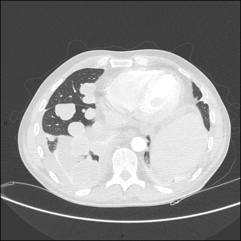 Cannonball metastases (Radiopaedia 82110-96150 Axial lung window 145).jpg