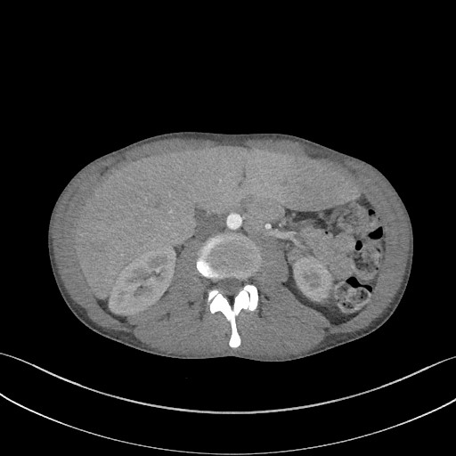Cannonball metastases - testicular choriocarcinoma (Radiopaedia 84510-99891 B 129).jpg