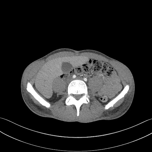 Cannonball metastases - testicular choriocarcinoma (Radiopaedia 84510-99891 B 150).jpg