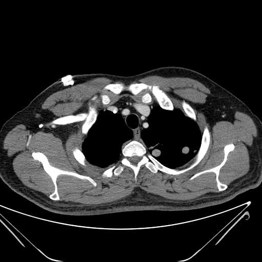 File:Cannonball pulmonary metastases (Radiopaedia 67684-77101 D 45).jpg