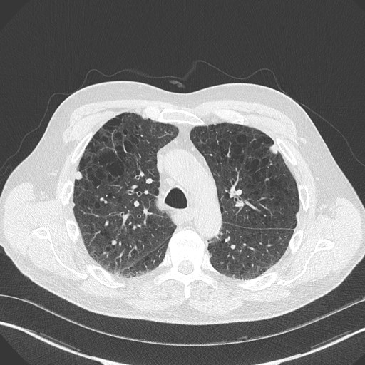 Caplan syndrome (Radiopaedia 56667-63530 Axial lung window 71).jpg