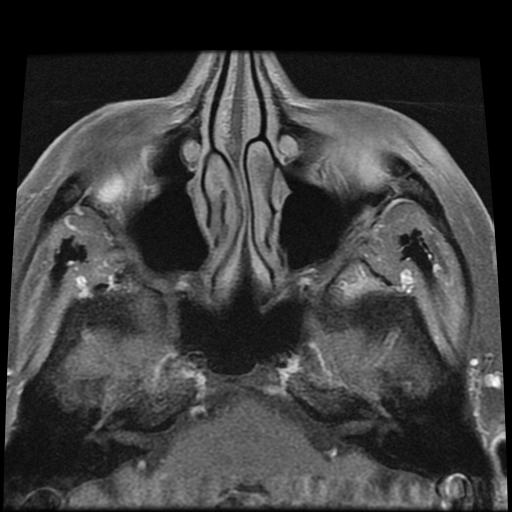 File:Carcinoid tumor of the ileum with metastasis to orbit (Radiopaedia 28165-28424 Axial T1 C+ fat sat 4).jpg