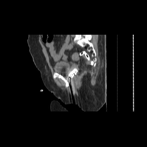 File:Carcinoma cervix- brachytherapy applicator (Radiopaedia 33135-34173 D 113).jpg
