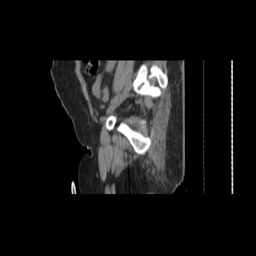 File:Carcinoma cervix- brachytherapy applicator (Radiopaedia 33135-34173 D 148).jpg