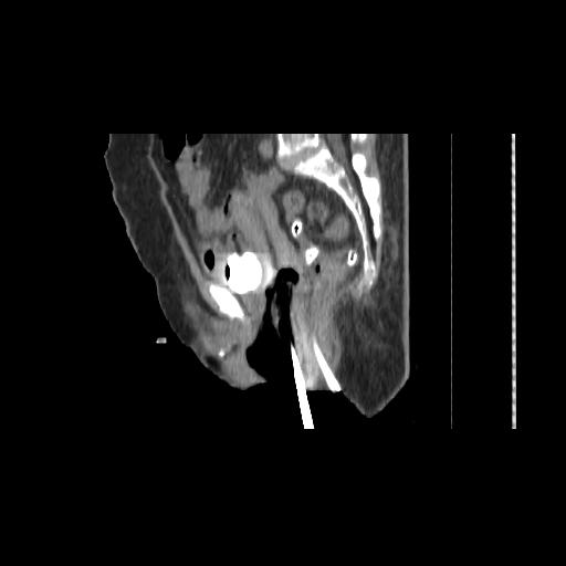 File:Carcinoma cervix- brachytherapy applicator (Radiopaedia 33135-34173 D 94).jpg