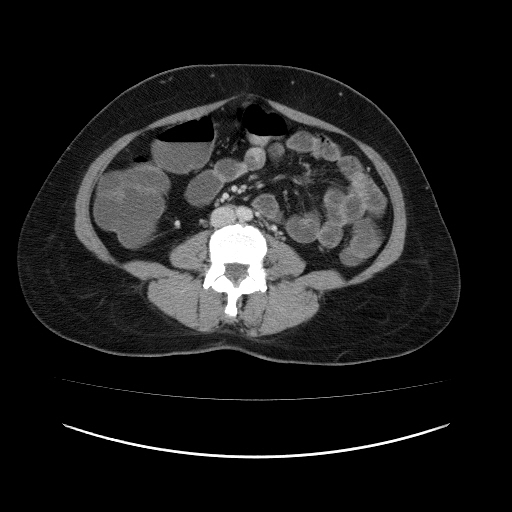 File:Carcinoma colon - hepatic flexure (Radiopaedia 19461-19493 A 72).jpg