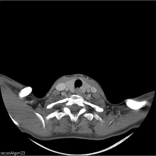 Carcinoma of the maxillary antrum (Radiopaedia 53805-59888 Axial C+ delayed 5).jpg