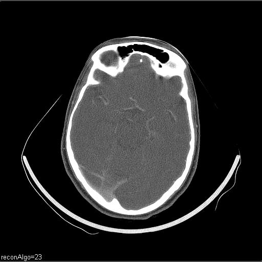 Carcinoma of the maxillary antrum (Radiopaedia 53805-59888 Axial C+ delayed 73).jpg