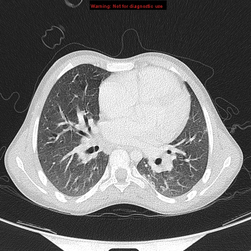 File:Cardiac bronchus (Radiopaedia 14059-13899 A 29).jpg