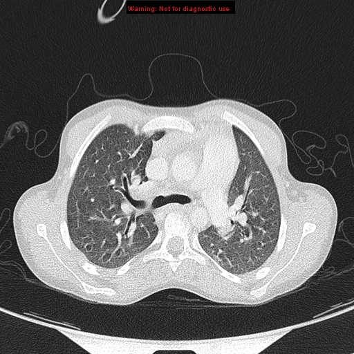 File:Cardiac bronchus (Radiopaedia 14059-13899 A 7).jpg