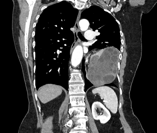 Cardiac hydatid disease (Radiopaedia 64684-73611 Axial reconstruction 37).jpg