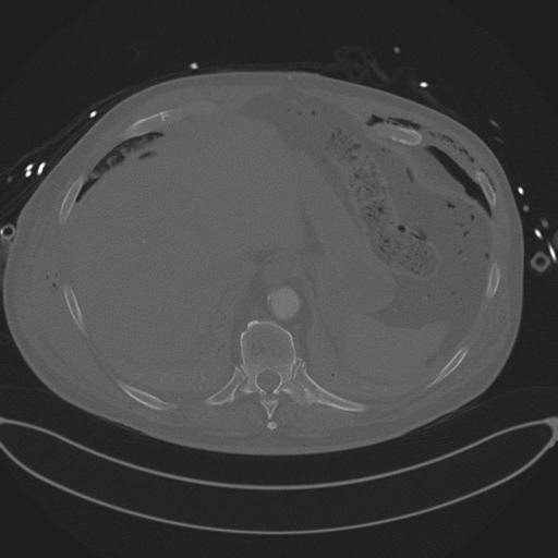 Cardiac trauma (Radiopaedia 32874-33858 Axial bone window 78).jpg