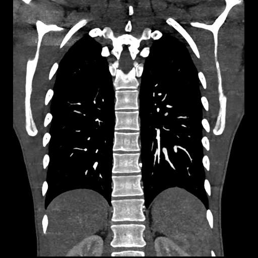 Cardiac tumor - undifferentiated pleomorphic sarcoma (Radiopaedia 45844-50134 Coronal non-contrast 54).png