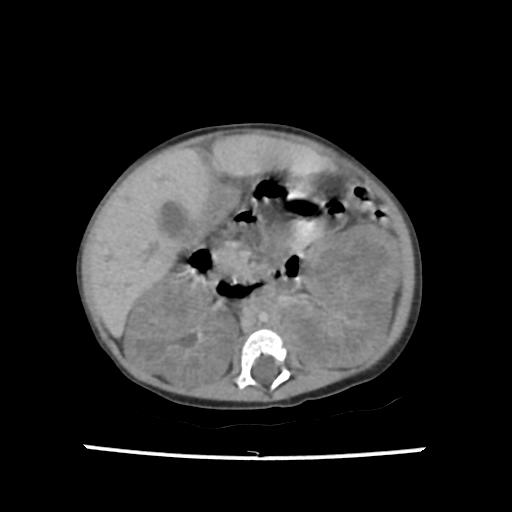 Caroli disease with autosomal recessive polycystic kidney disease (ARPKD) (Radiopaedia 89651-106703 B 105).jpg