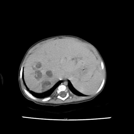 Caroli disease with autosomal recessive polycystic kidney disease (ARPKD) (Radiopaedia 89651-106703 B 32).jpg